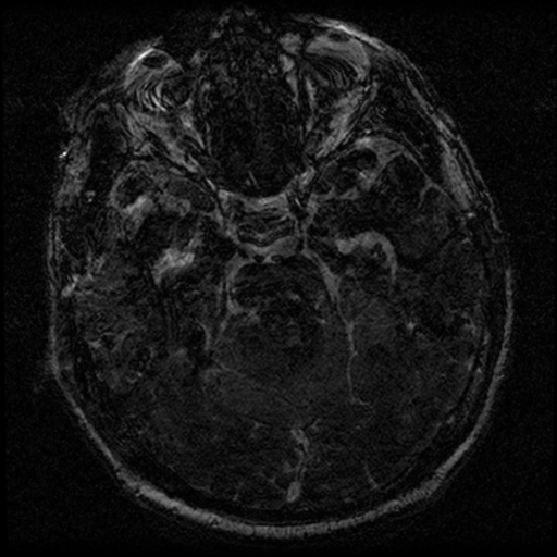 File:Acoustic schwannoma (Radiopaedia 39170-41387 Axial FIESTA 110).png