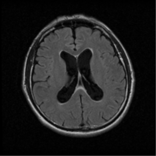File:Acoustic schwannoma (Radiopaedia 39170-41387 Axial FLAIR 13).png