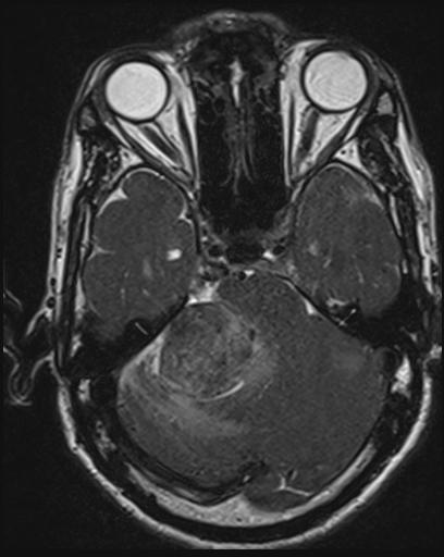 Acoustic schwannoma - probable (Radiopaedia 20386-20292 Axial T1 45).jpg