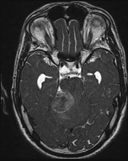 Acoustic schwannoma - probable (Radiopaedia 20386-20292 Axial T1 54).jpg