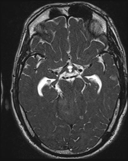 File:Acoustic schwannoma - probable (Radiopaedia 20386-20292 Axial T1 60).jpg