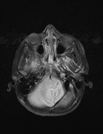 File:Acquired cerebellar tonsillar ectopia (Radiopaedia 39950-42423 Axial FLAIR 4).jpg