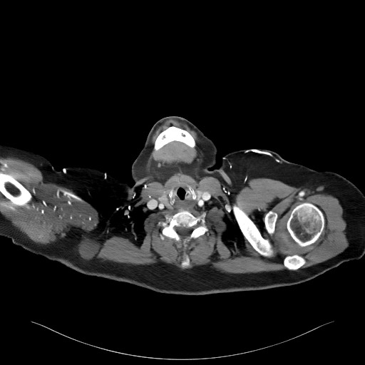 Acromioclavicular joint cyst (Radiopaedia 58455-65610 Axial C+ arterial phase 11).jpg