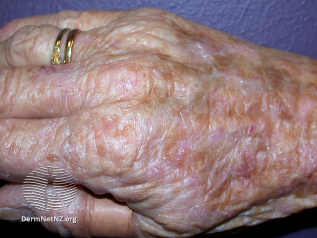 File:Actinic keratoses affecting the hands (DermNet NZ lesions-ak-hands-393).jpg