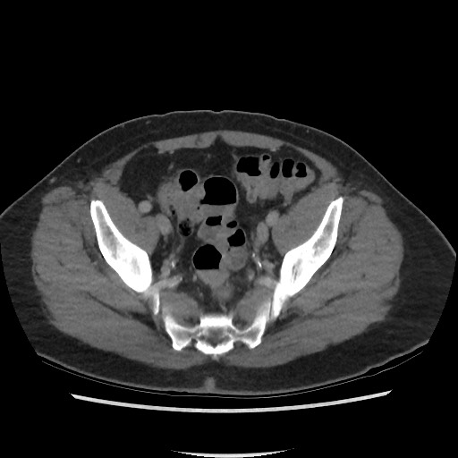 File:Active colonic bleed on CT (Radiopaedia 49765-55025 Axial C+ delayed 69).jpg