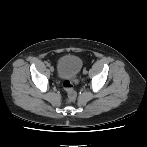 Active colonic bleed on CT (Radiopaedia 49765-55025 Axial non-contrast 72).jpg