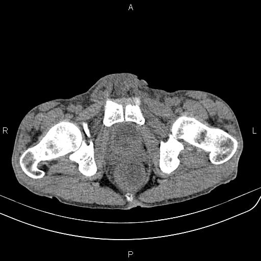 Active crohn disease (Radiopaedia 87133-103397 Axial non-contrast 102).jpg