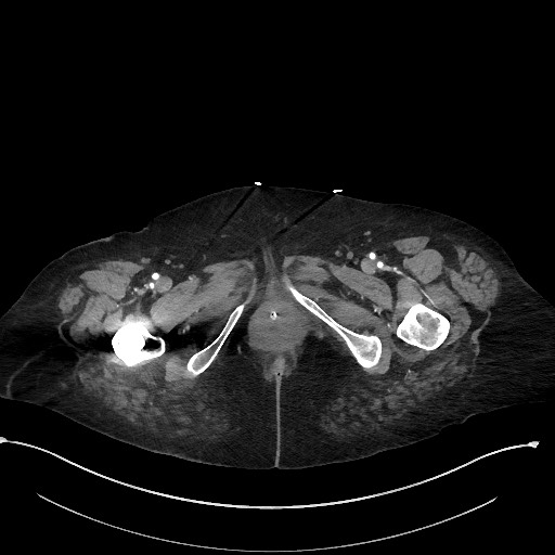 Active renal extravasation with large subcapsular and retroperitoneal hemorrhage (Radiopaedia 60975-68796 Axial C+ arterial phase 211).jpg