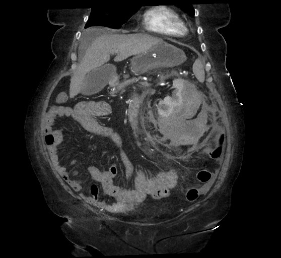 Active renal extravasation with large subcapsular and retroperitoneal hemorrhage (Radiopaedia 60975-68796 Coronal C+ arterial phase 54).jpg