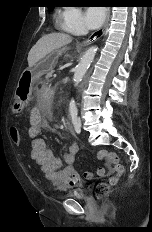 Active renal extravasation with large subcapsular and retroperitoneal hemorrhage (Radiopaedia 60975-68796 Sagittal C+ portal venous phase 120).jpg