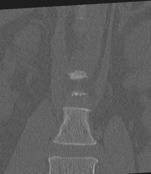 Acute L1 burst compression fracture (Radiopaedia 34430-35755 Coronal bone window 12).png