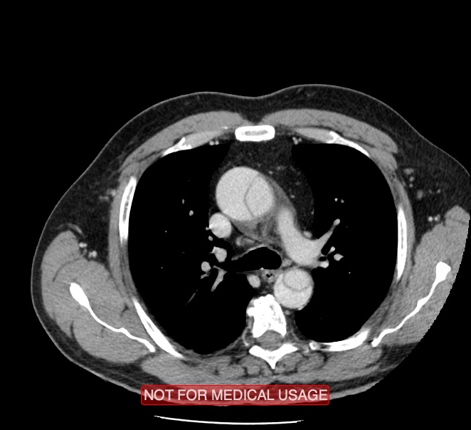 Acute aortic dissection - Stanford type A (Radiopaedia 40661-43285 Axial C+ portal venous phase 13).jpg