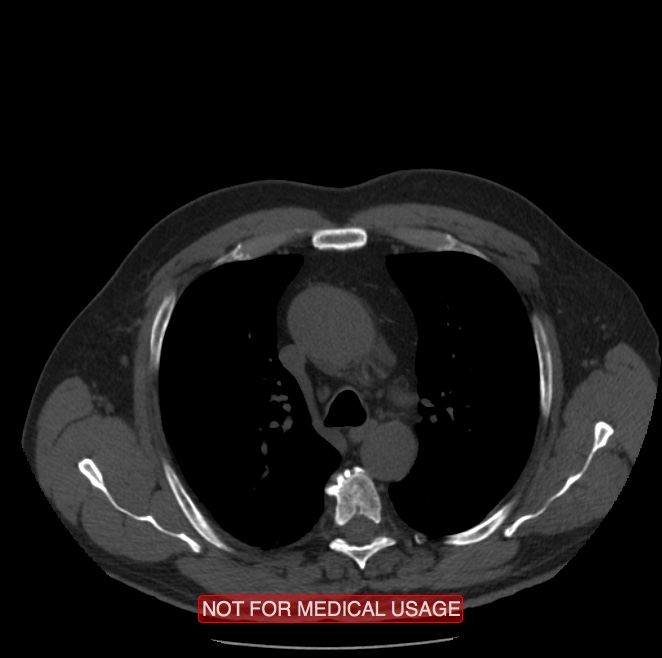 Acute aortic dissection - Stanford type A (Radiopaedia 40661-43285 Axial non-contrast 12).jpg