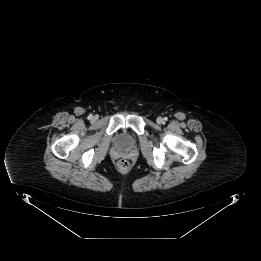 Acute appendicitis, heterotaxy syndrome (Radiopaedia 66884-76202 Axial C+ portal venous phase 130).jpg