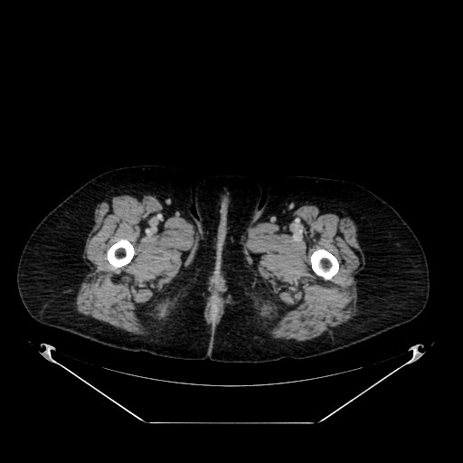 Acute appendicitis, heterotaxy syndrome (Radiopaedia 66884-76202 Axial C+ portal venous phase 147).jpg