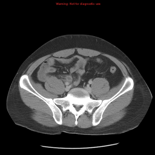 Acute appendicitis (Radiopaedia 10498-10973 Axial C+ portal venous phase 27).jpg