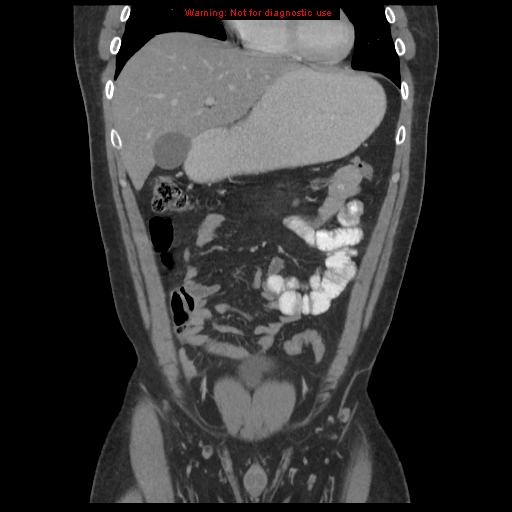 File:Acute appendicitis (Radiopaedia 10498-10973 F 1).jpg