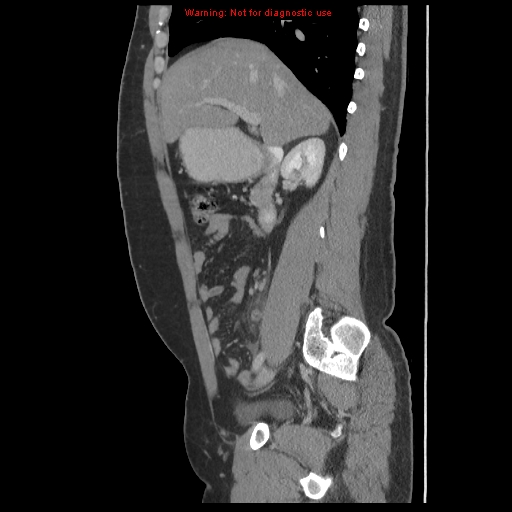 File:Acute appendicitis (Radiopaedia 10498-10973 Sagittal C+ portal venous phase 14).jpg