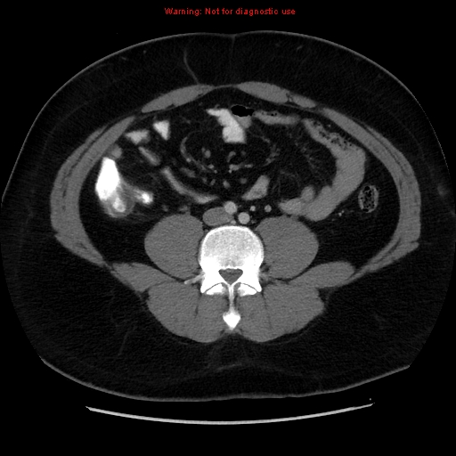 File:Acute appendicitis (Radiopaedia 12326-12607 Axial C+ portal venous phase 10).jpg