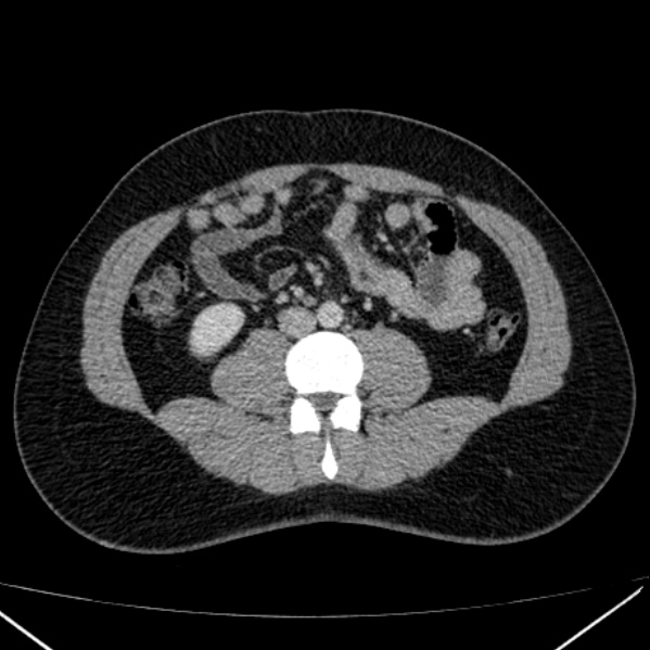 File:Acute appendicitis (Radiopaedia 38255-40270 Axial C+ portal venous phase 58).jpg