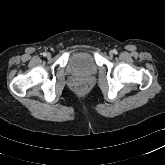 Acute appendicitis (Radiopaedia 48792-53822 Axial C+ portal venous phase 118).jpg
