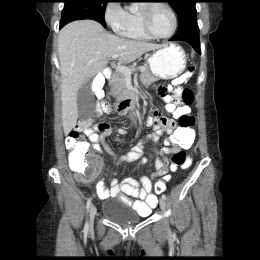 Acute appendicitis (Radiopaedia 52672-58589 Coronal C+ portal venous phase 28).jpg