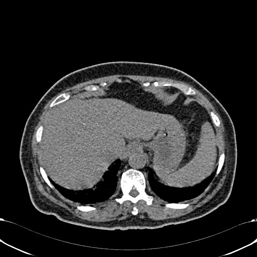 Acute appendicitis (Radiopaedia 58627-65818 Axial non-contrast 15).jpg