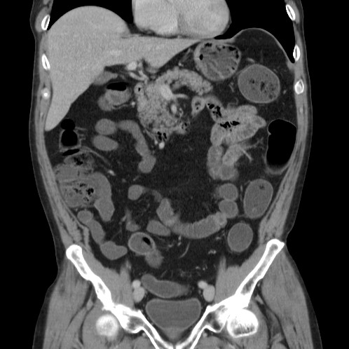 Acute appendicitis (Radiopaedia 66513-75790 Coronal C+ portal venous phase 29).jpg