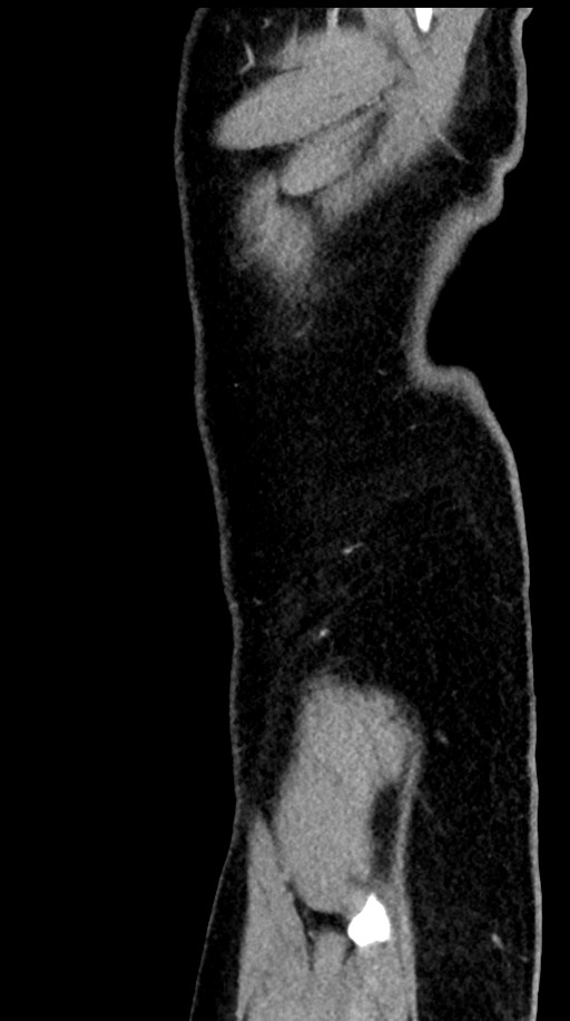 Acute appendicitis (Radiopaedia 77016-88960 Sagittal C+ portal venous phase 109).jpg