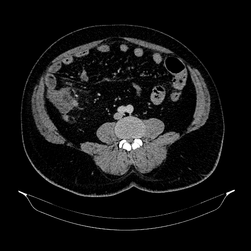 Acute appendicitis (Radiopaedia 79950-93224 Axial C+ portal venous phase 62).jpg