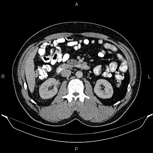File:Acute appendicitis (Radiopaedia 84780-100240 Axial C+ portal venous phase 45).jpg