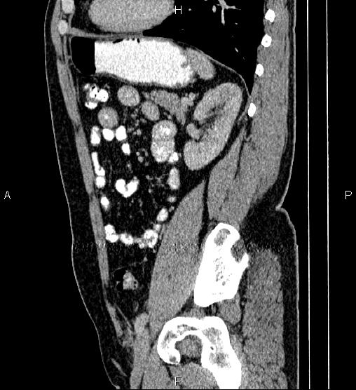 Acute appendicitis (Radiopaedia 84780-100240 Sagittal C+ portal venous phase 74).jpg