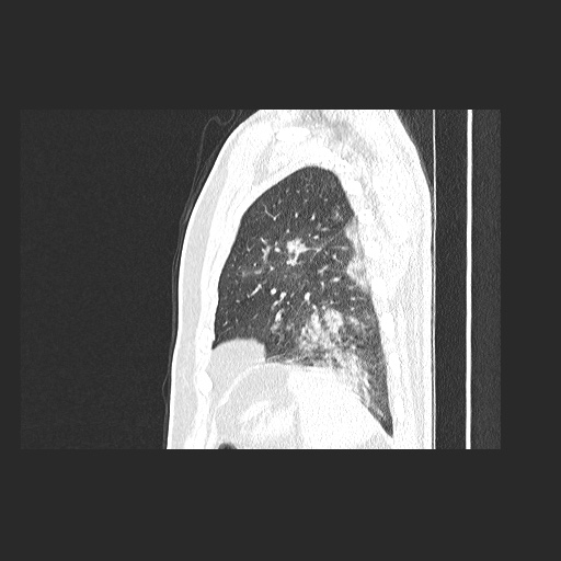 Acute appendicitis and COVID 19 pneumonia (Radiopaedia 76604-88380 Sagittal lung window 76).jpg