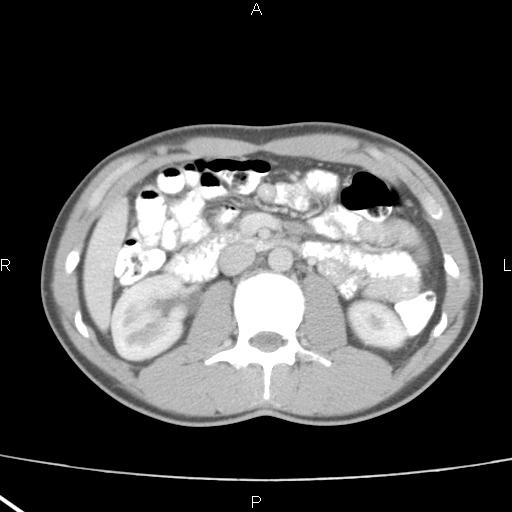 File:Acute appendicitis with CT arrowhead sign (Radiopaedia 21474-21411 Axial C+ portal venous phase 16).jpg