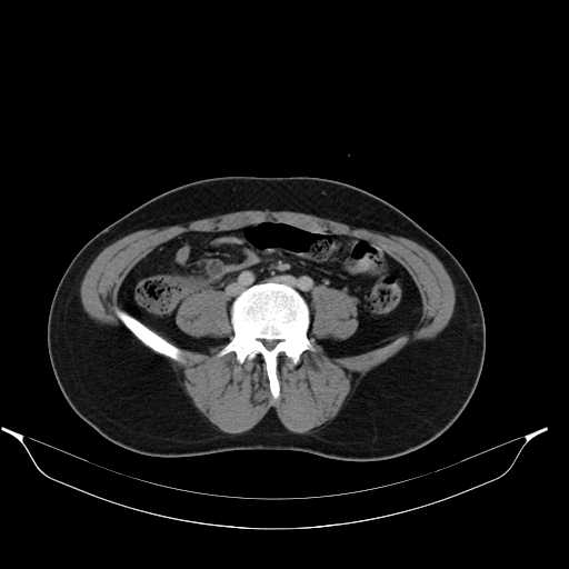 File:Acute appendicitis with appendicoliths (Radiopaedia 21148-21062 Axial C+ portal venous phase 8).jpg