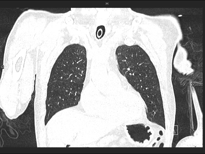 File:Acute aspiration pneumonitis (Radiopaedia 55642-62166 Coronal lung window 30).jpg