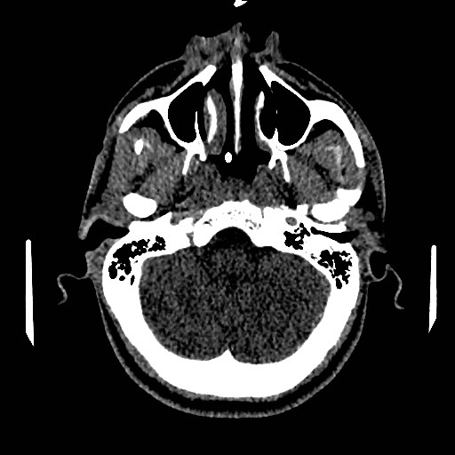 File:Acute basilar artery occlusion (Radiopaedia 43582-46985 Axial non-contrast 45).jpg