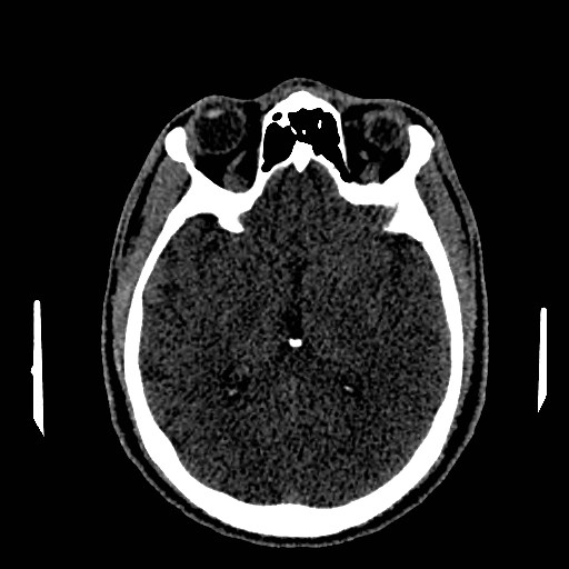 Acute basilar artery occlusion (Radiopaedia 43582-46985 Axial non-contrast 90).jpg