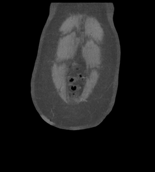 Acute bleed from gastric fundus biopsy site (Radiopaedia 35201-36737 Coronal C+ arterial phase 7).png