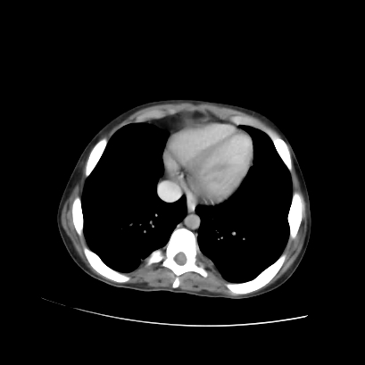 Acute calculous cholecystitis in patient with osteopetrosis (Radiopaedia 77871-90159 Axial C+ portal venous phase 14).jpg
