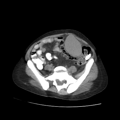 File:Acute calculous cholecystitis in patient with osteopetrosis (Radiopaedia 77871-90159 Axial non-contrast 59).jpg