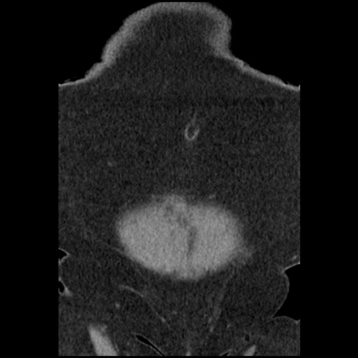 Acute cholecystitis and ureteric colic (Radiopaedia 42330-45444 Coronal prone 16).jpg