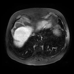 Acute cholecystitis complicated by pylephlebitis (Radiopaedia 65782-74915 Axial arterioportal phase T1 C+ fat sat 5).jpg