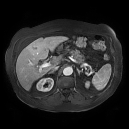 Acute cholecystitis complicated by pylephlebitis (Radiopaedia 65782-74915 Axial arterioportal phase T1 C+ fat sat 52).jpg