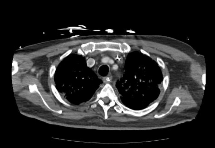 Acute cor pulmonale (ultrasound) (Radiopaedia 83508-98818 Axial C+ CTPA 13).jpg