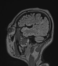 Acute disseminated encephalomyelitis (ADEM)- Anti-NMDA receptor encephalitis (Radiopaedia 54920-61201 Sagittal FLAIR 66).png