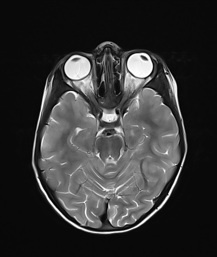 File:Acute disseminating encephalomyelitis with bilateral optic neuritis (Radiopaedia 79676-92886 Axial T2 9).jpg
