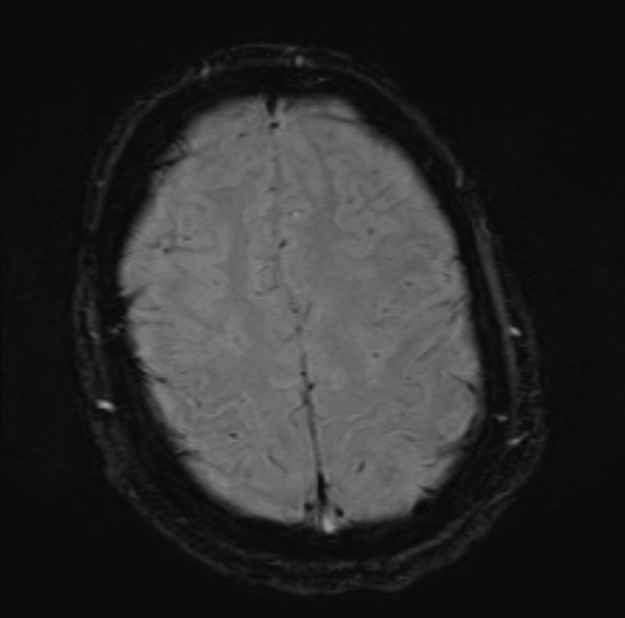Acute ischemic stroke - posterior circulation territory (Radiopaedia 77670-89880 Axial SWI 46).jpg