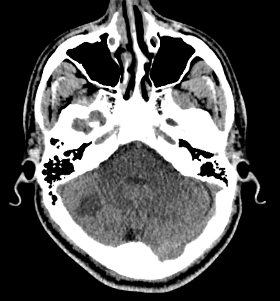 Acute ischemic stroke - posterior circulation territory (Radiopaedia 77670-89881 non-contrast 19).jpg