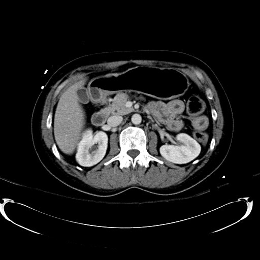 File:Acute myocardial infarction in CT (Radiopaedia 39947-42415 Axial C+ portal venous phase 49).jpg